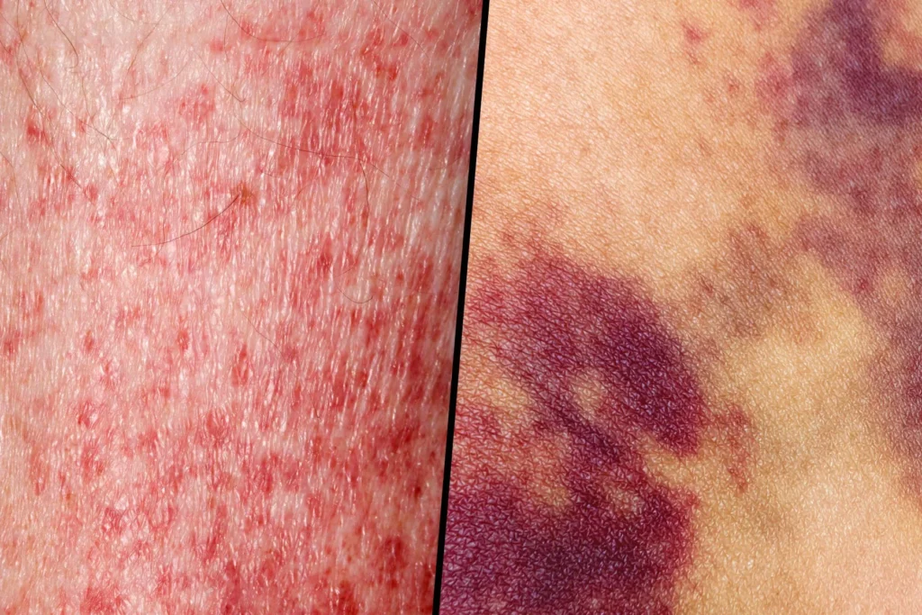 Leukemia