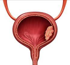 Understanding Bladder Cancer