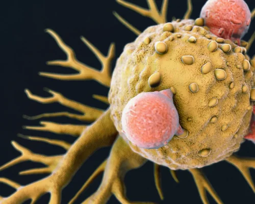 Solid Tumor Management Solid Tumor Management